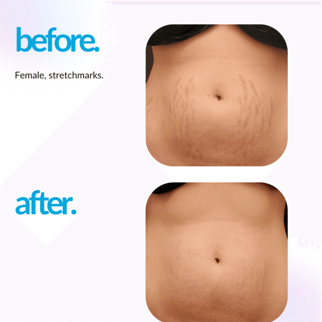 Procell + Carboxy Body Series at Santosha Skin in Albuquerque, NM